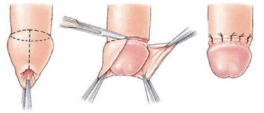 Sünnet - İnmemiş Testis